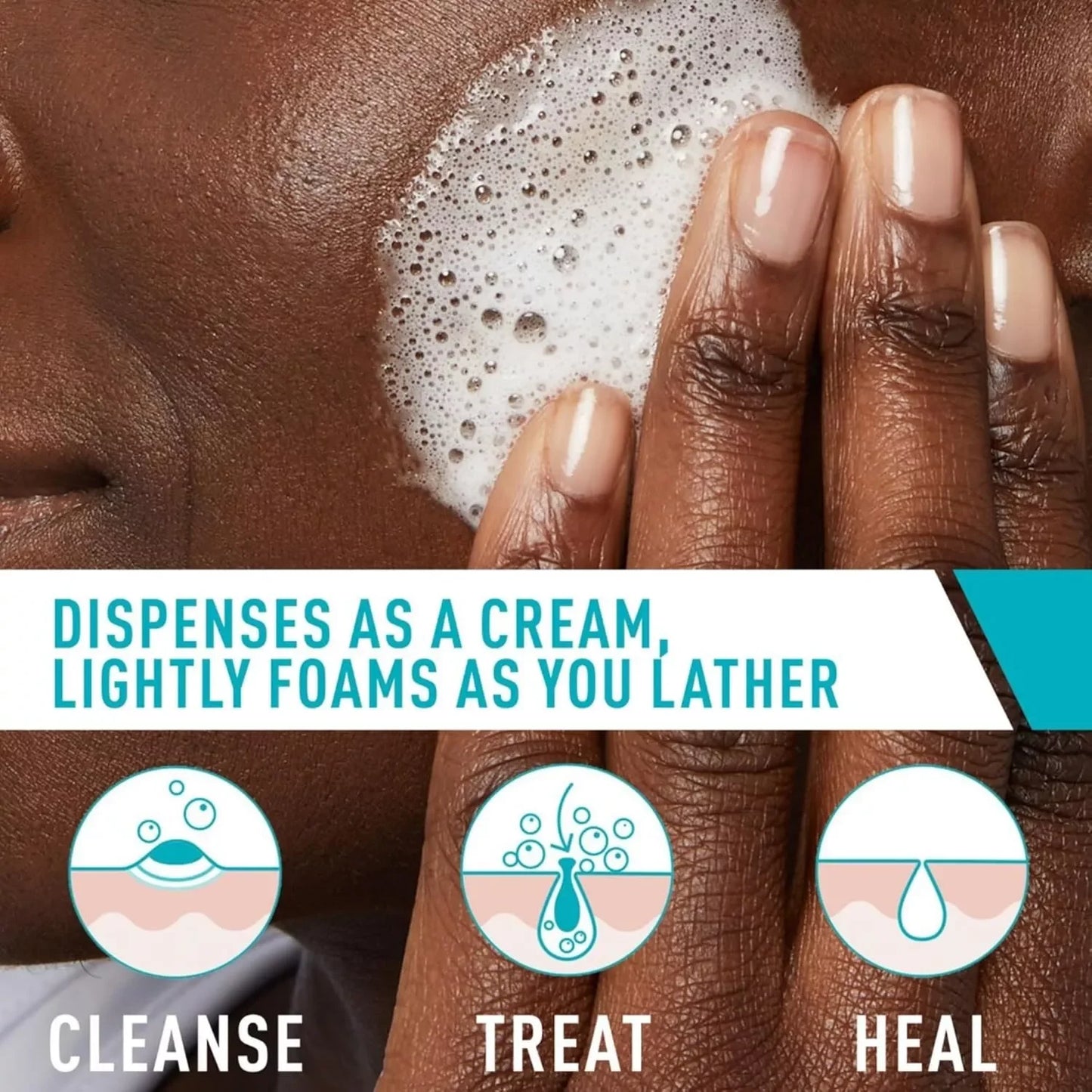 CeraVe Acne Foaming Cream Cleanser | Acne Treatment Face Wash with 4% Benzoyl Peroxide and Niacinamide | 5 fl oz - Exotic Pro